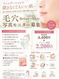 毛穴黒ずみ＆開き改善Before After写真モニター募集