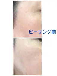 👆毛穴ケアはピーリングです。👆ピーリング+フェイシャルトリートメント
