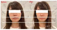 フェイシャル小顔コース45分コース
