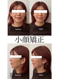【★平日限定】小顔矯正フルコース(エラ/たるみ改善/ほうれい線)\10000→ 価格:1000円