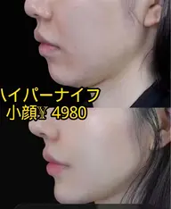 大人気🌸ハイパーナイフ小顔✨コルギとスキンケア込み✨50分¥ 4980