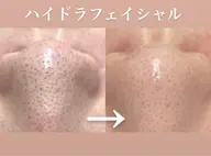口コミ投稿限定！【毛穴洗浄】黒ずみ/いちご鼻に👃濃密ホワイトハニーで美肌へ♪