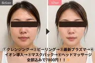 最新プログラムエステ♪ダウンタイム無し（機械で保湿付き♪）