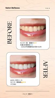 【モニター様募集中】40分照射×３回コース※口元の写真撮影にご協力いただける方限定