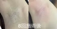 全身脱毛(ドイツ製のハイブリッドの機使用)圧倒的な効果是非お試しください!こちらは初回のみになります!🙇