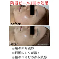 《ニキビ毛穴レスツヤ肌コース》