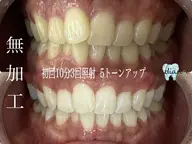 【初回のみ】1日完結☆セルフホワイトニング15分2回照射☆本数無制限