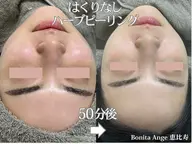【症例モニター様◆募集】毛穴・ニキビ・肌荒れにお悩みの方『剥離なしハーブピーリング』ダウンタイムなし　¥6660