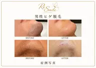【人気NO.2】ヒゲ脱毛 通常¥9,800⇒3,000