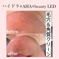 【皮脂・毛穴洗浄】角質ピーリング×LEDコラーゲンドーム