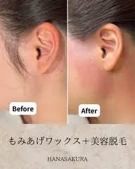 もみあげワックス脱毛+美容脱毛(要口コミ)