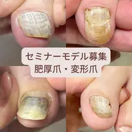 【通常24,200円→無料】巻き爪・肥厚爪・変形爪・魚の目・タコ・角質セミナーモデル募集📣