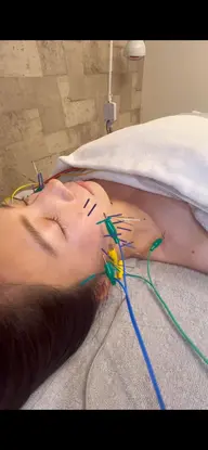 【美容鍼】憧れのすっきりフェイスライン♪ヒト幹細胞培養美容液付き