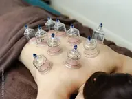 カッピング