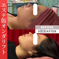 【二重顎・たるみ】エステ版オンダリフト 150kj 顎下➕フェイスライン ¥13,000