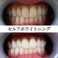 【初回限定】オススメ！ホワイトニング体験コース20分照射