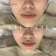 【🩷SNS掲載🆗の方🩷】ウルトラVリフト✨H I F U モデル募集です❤️🔥⭐️速攻小顔効果抜群⭐️