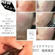 【シミケアメニュー】スタンダードケア クレンジング→シミケア→肌別パック 《10分打ち放題》
