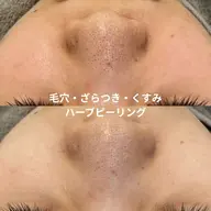 【初回】ハーブピーリング🌿毛穴・ざらつき・くすみが気になる方へ