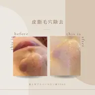 フェイシャル皮脂毛穴洗浄