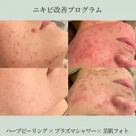 【赤み 炎 症 ニキビ】根本改善プログラム◇プラズマ×ハーブ🌿×美肌フォト
