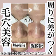 SNSで大人気‼️始めた人から綺麗に‼️毛穴美人コース、ラボーテ式毛穴エクストラクションプロ