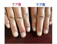 甘皮ケアのみ