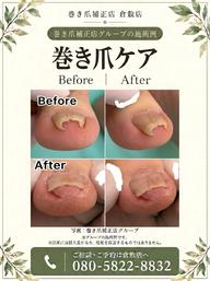 【巻き爪補正】1爪の巻き爪補正✨痛い巻き爪😣は早めのケアが大切💡形が気になる方もご相談ください💁♀️