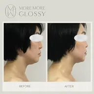 【エイジングサイン対策】たるみ、ほうれい線によるフェイスラインのもたつき悩みに特化📣💎眠れる美女コルギ70分💆
