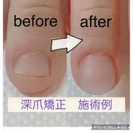 ウォーターケア+深爪矯正にも⭐︎アクリルスカルプチュア