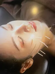【睡眠時の食いしばりや睡眠状況が悪い方】美容鍼+お顔のEMS