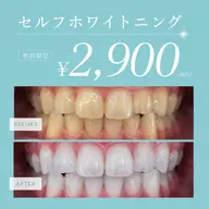 💎セルフホワイトニングで輝く白い歯へ✨