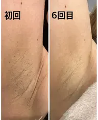 脇脱毛