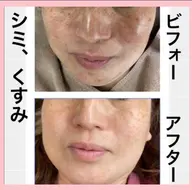 🌿ハーブピーリングハード&毛穴洗浄、角質除去、美容保湿🌿吹き出物、吹き出物跡、毛穴、美白、黒ずみ、肌質ケアに