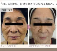 潤い&引き上げ《毛穴/リフトアップ/小顔/キメ/美肌/艶肌》エンダモロジーフェイシャル+エレクトロポレーション