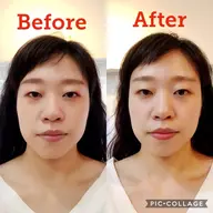 小顔矯正