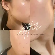 【人気NO2!自分史上最高のツヤ肌に】毛穴洗浄×剥離なしハーブピーリング×WAX脱毛│毛穴悩み/ニキビ/ニキビ跡/くすみ