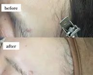 つるんと垢抜け肌に◎沈静パック付きフェイシャルWAX