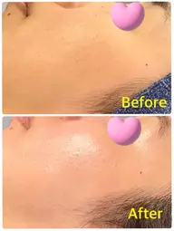 水光パック付き💕 ヒト幹細胞×ハーブピーリング🌿【剥離なし】