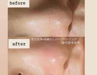 【人気NO1👑】毛穴洗浄×ハーブピーリング40分｜鼻などの黒ずみ・角栓徹底除去◎悩んだらコレ／男性+￥1,000