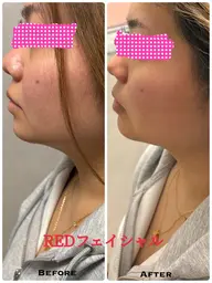 💎【フェイスライン引き締め】小顔リフトケア　お肌を錆びさせない効果のある美容液使用