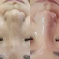 10名限定毛穴モニター✨小鼻のW毛穴洗浄!韓国水光肌🫧
