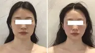 【美顔フェイスラインスッキリ】レモンぼとるフェイシャル