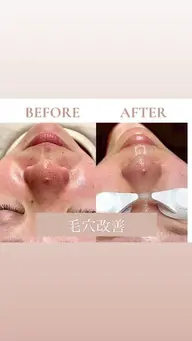 【黒ずみ•開き毛穴に】🌷毛穴改善フェイシャル🌷