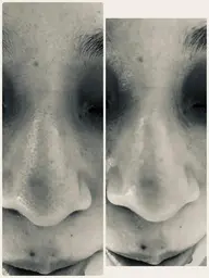 ブツブツ毛穴👃コース★黒ずみ毛穴★たるみ毛穴★開き毛穴★皮脂毛穴