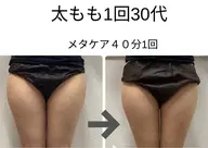 【脂肪に直接アプローチ!効果絶大】メタケア+ハンドケア(1パーツ) 40分¥15,600→¥6,000
