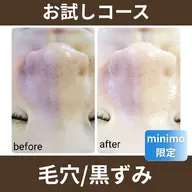 【お試し】ハーブピーリング