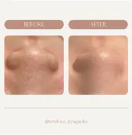 【本日限定‼️フェイシャル🌿】ハイドラ毛穴洗浄🍓+ハーブピーリング🌿+鎮静パック💆🏻♀️