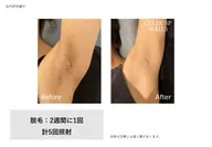 ワキ脱毛