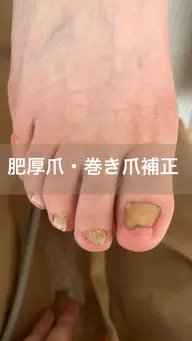 巻き爪補正+ワンカラー